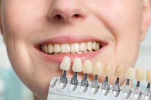 dental veneers tx, person holding up veneers to their real teeth