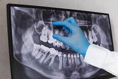 dental x-rays beaumont tx dentist reading Dental X-Rays