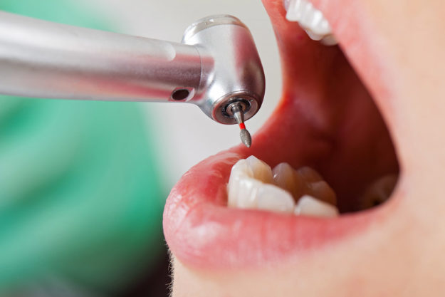 common dental problems mouth being worked on for common dental problems