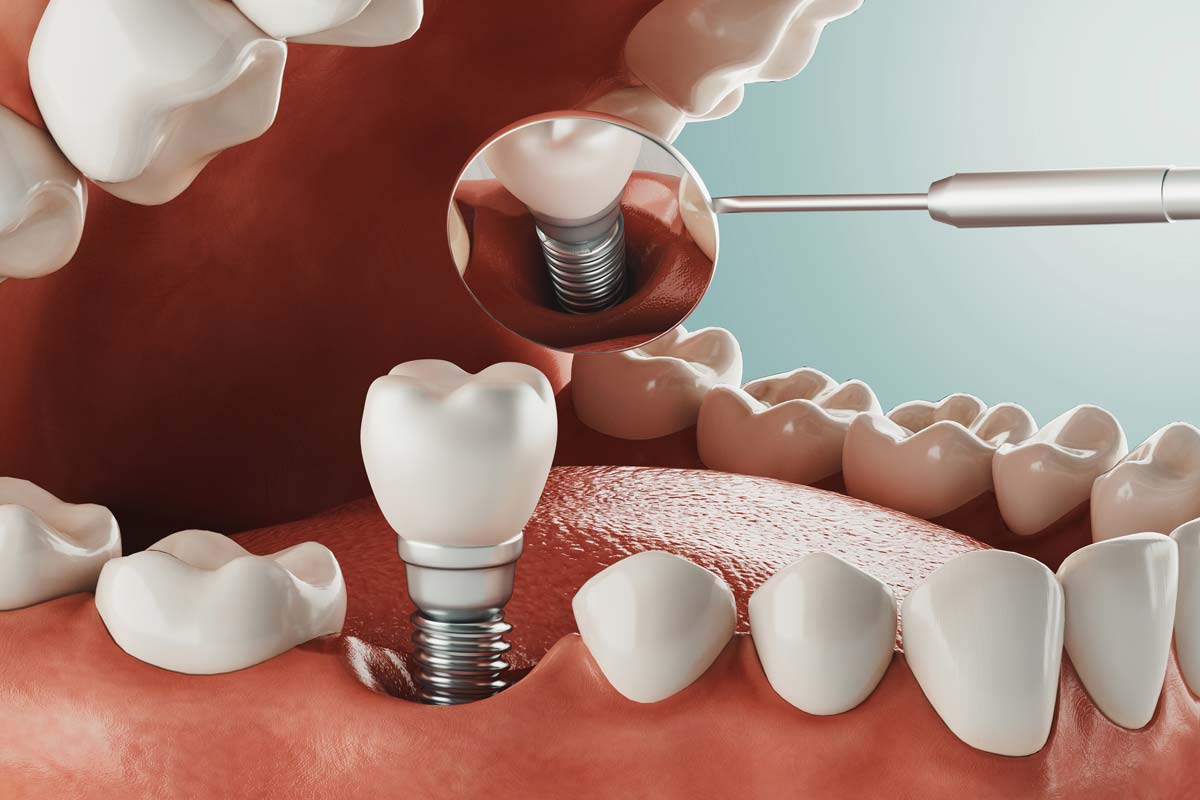 dental-implants (1) looking at dental implants