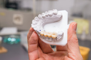 teeth mold showing dental crowns and bridges