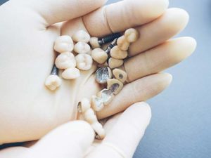 a handful of dental implants