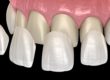 dental veneers
