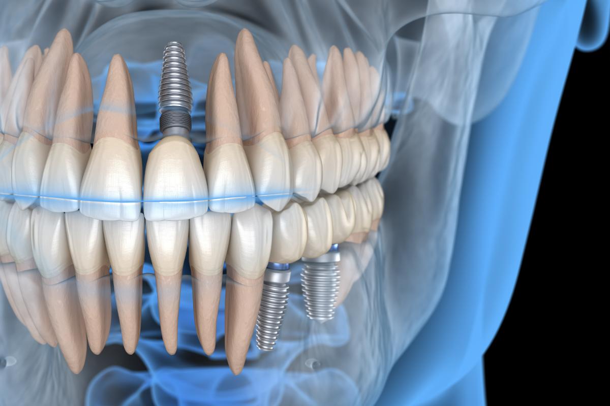 dental implants